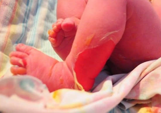 婴儿出生两天妇幼院洗澡 全身被烫伤43%(图)